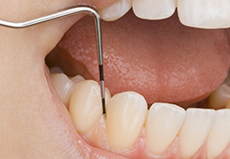 STEP7 歯周病治療