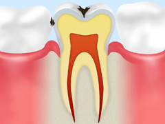 C1 初期の虫歯