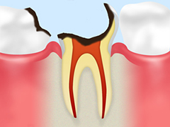根管治療が必要なケース