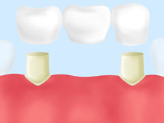 短期間で治療が完了するブリッジ