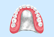 チタン床義歯