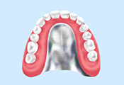 コバルトクロム床義歯