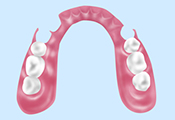ノンクラスプ義歯