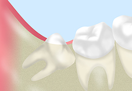 親知らずの抜歯などもご相談ください